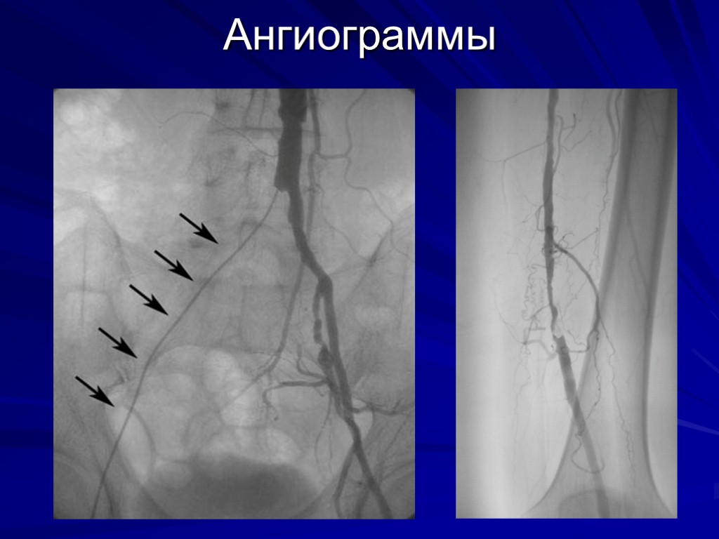 Заболевания артерий нижних конечностей презентация